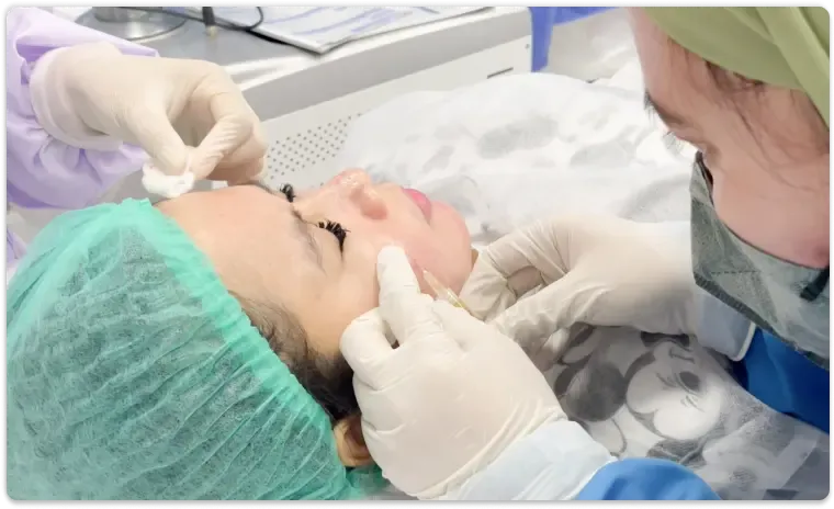 Platelet Rich Plasma (PRP) with Subcision