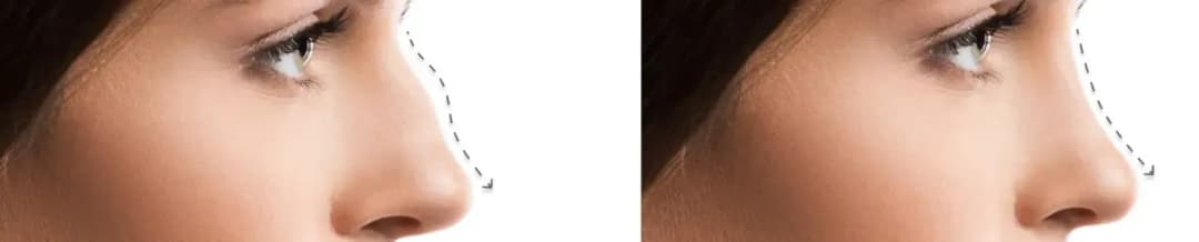 Rhinoplasty Rib Cartilage